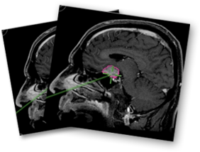 Endonasal